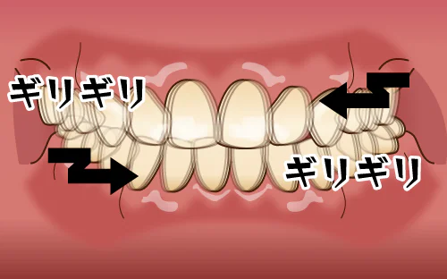 歯のこすり合わせ（グラインディング）