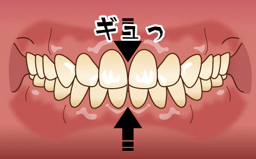 歯のかみしめや食いしばり（クレンチング）