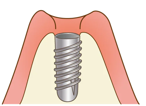 インプラント体の埋入と治癒