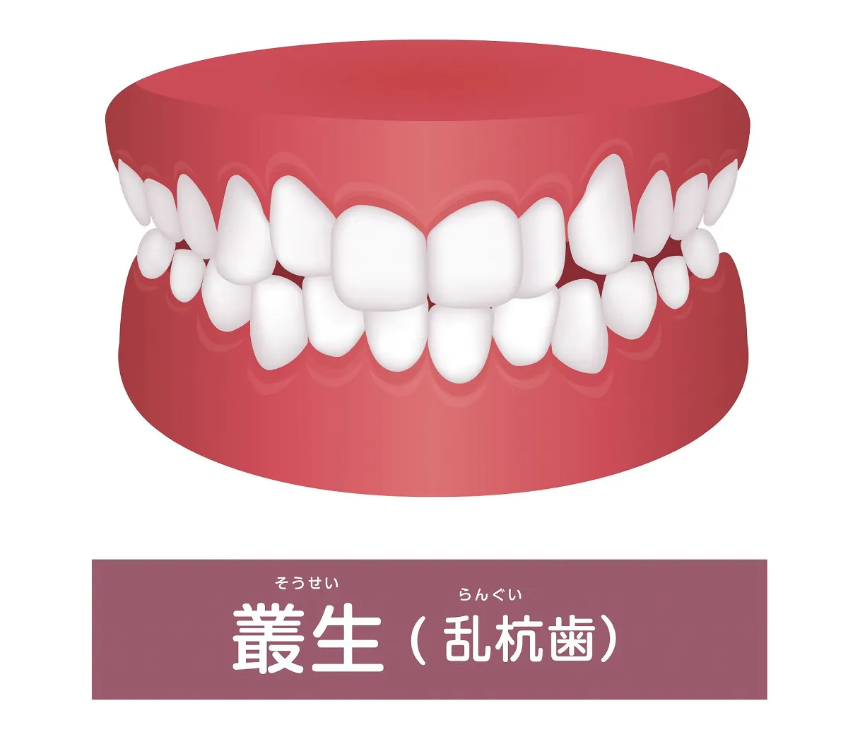 八重歯、ガチャ歯、乱杭歯（叢生）