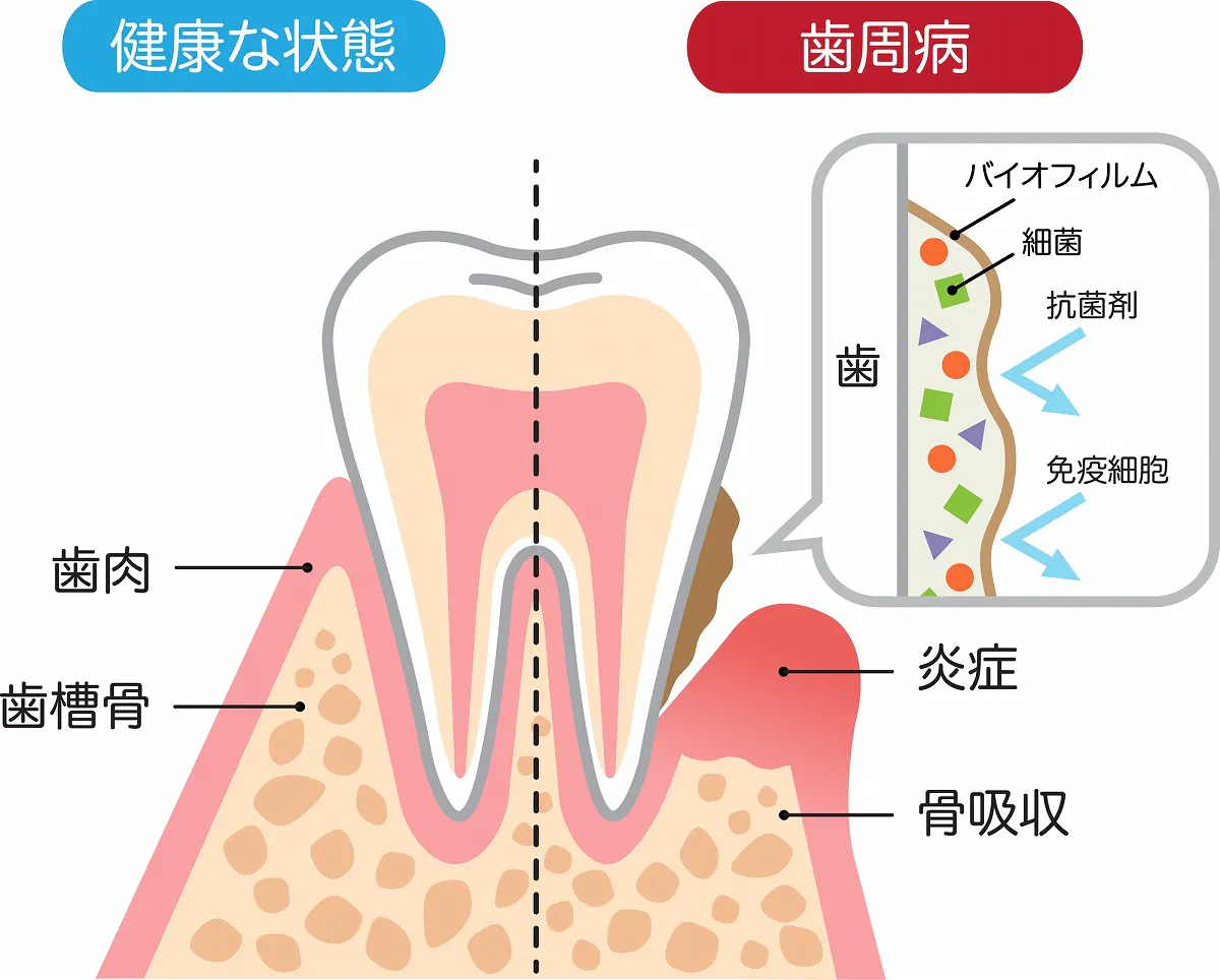 歯周病の原因は「プラーク（歯垢）」