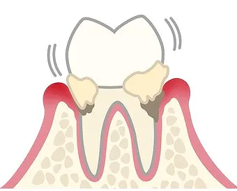 軽度の歯周炎