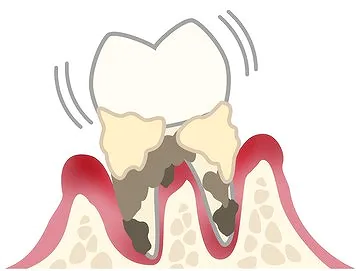 重度の歯周炎