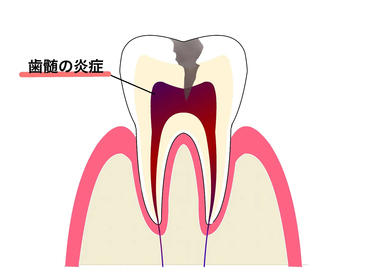 歯髄炎