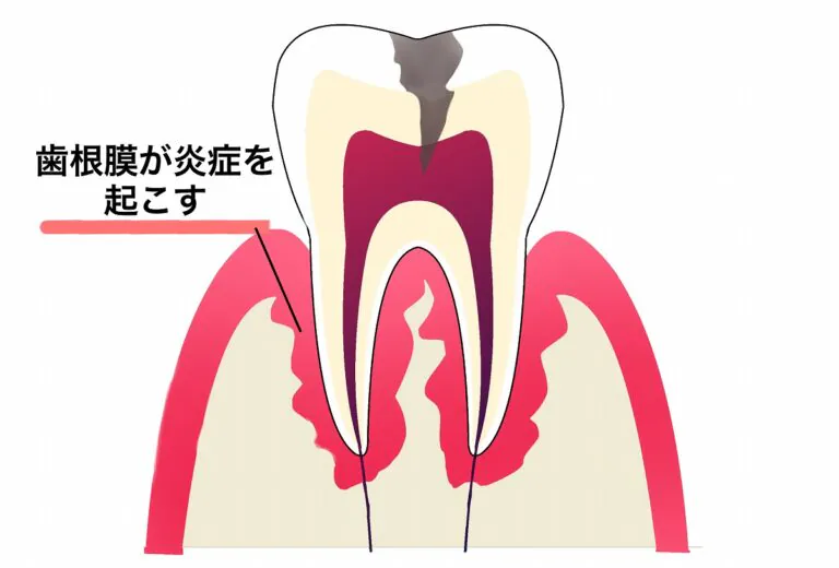 歯根膜炎