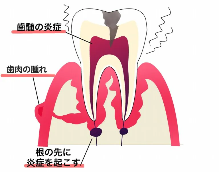 根尖性歯周炎