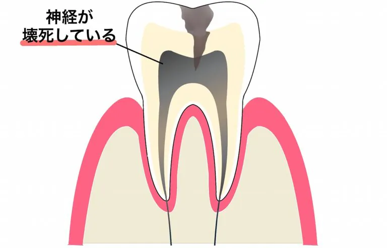 歯髄壊死